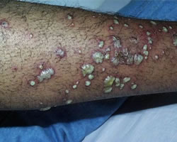 MRSA image 1 &ndash; quite graphic