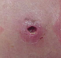 MRSA image 2 &ndash; quite graphic