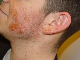 MRSA image 3 &ndash; quite graphic
